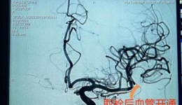 【大醫(yī)精誠在湖一】八旬老人突發(fā)急性缺血性腦卒中，醫(yī)院上演“生命接力”