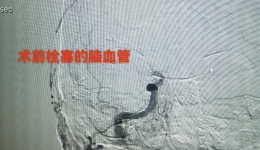 【卓越醫(yī)療在湖一】 90歲老人突發(fā)腦梗死，介入取栓技術(shù)創(chuàng)造生命奇跡