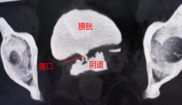 【卓越醫(yī)療在湖一】 復(fù)雜性膀胱陰道瘺：困擾桂女士半年的“漏尿”痛楚沒啦！